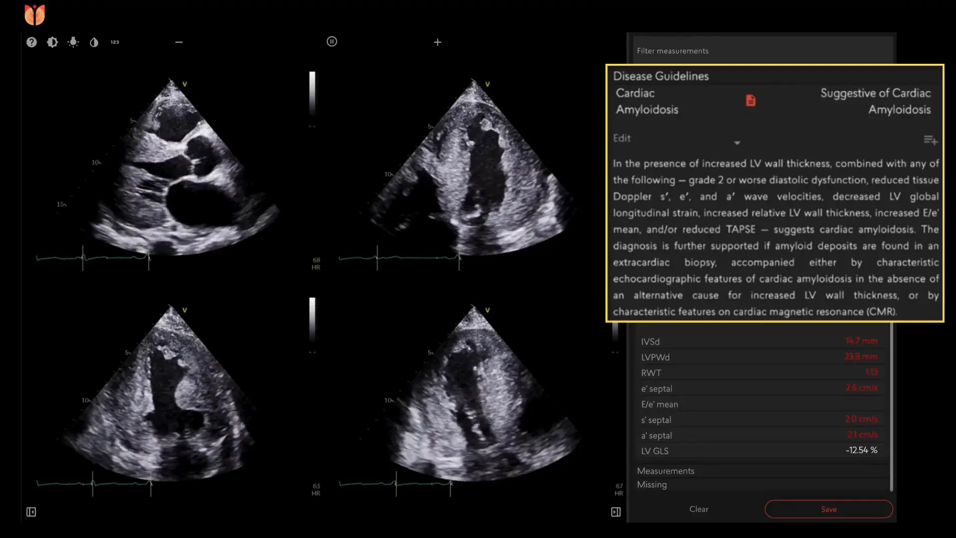 Us2.ai automated measurements overlaid on an echocardiogram